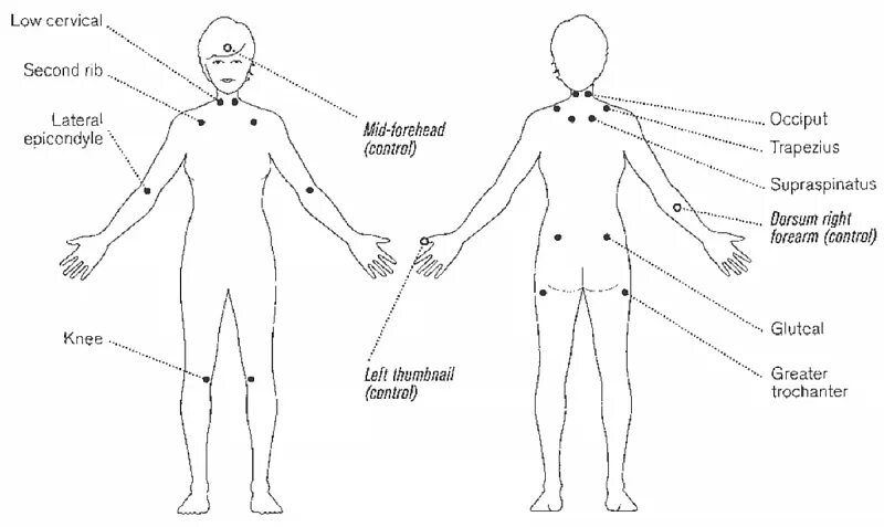18 болезненный. Фибромиалгия болевые точки схема. Триггерные точки фибромиалгии. Фибромиалгия триггерные точки схема. Фибромиалгия диагностические критерии.