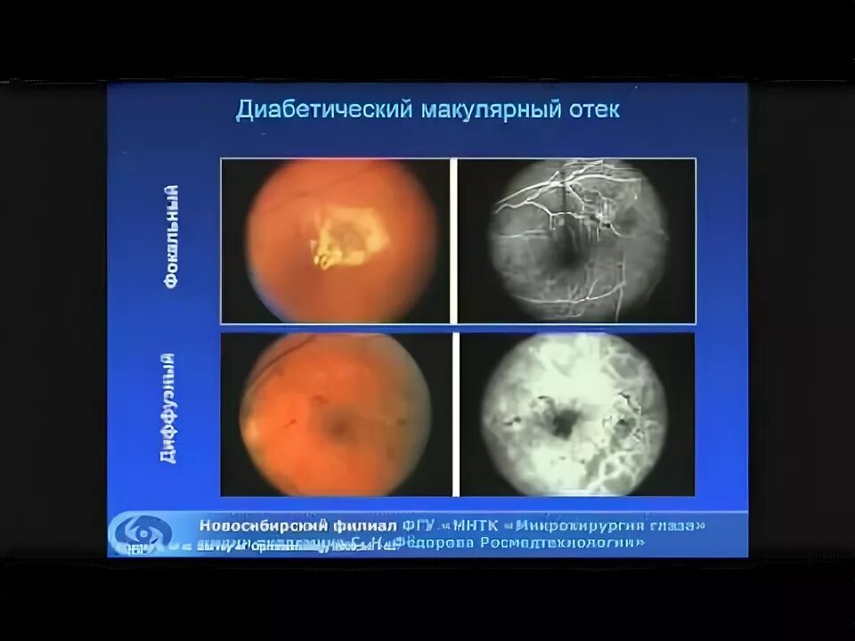 Макулярный отек лечение. Кистозный макулярный отек. Диабетический макулярный отек. Диабетический макулярный отек (ДМО). Макулярный отек сетчатки глаза.