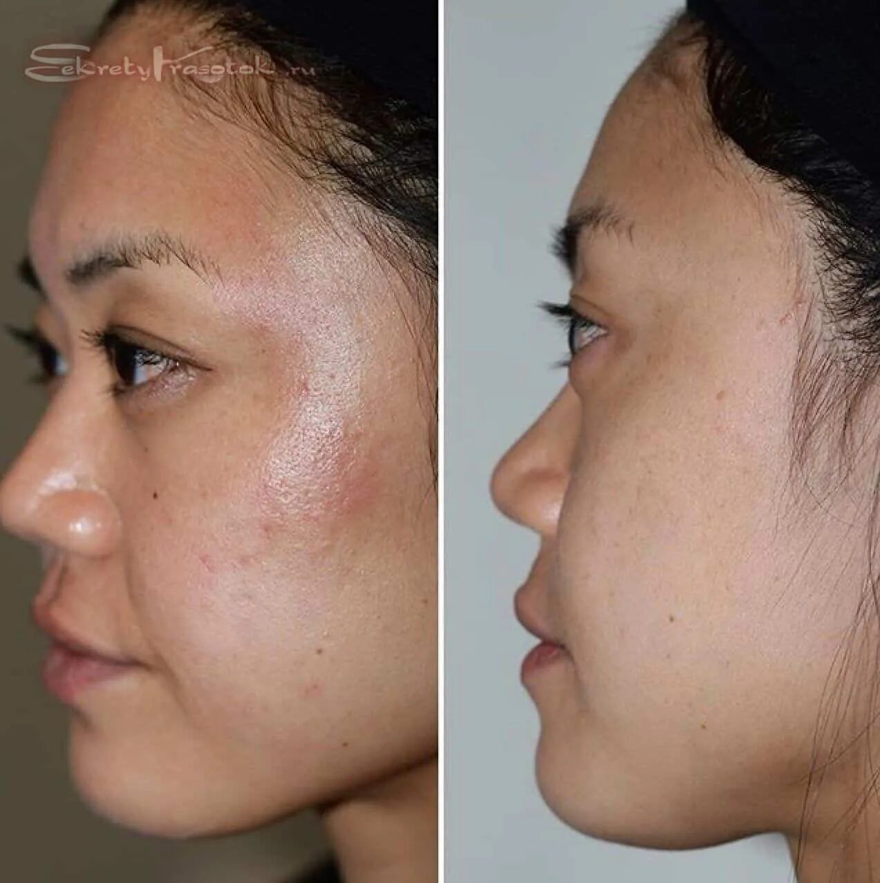 После лазерной вапоризации. Сепарирование кожи лица. Сепарирование кожи лица до и после. Вапоризация кожи лица. Дарнсальваль результат кожа.