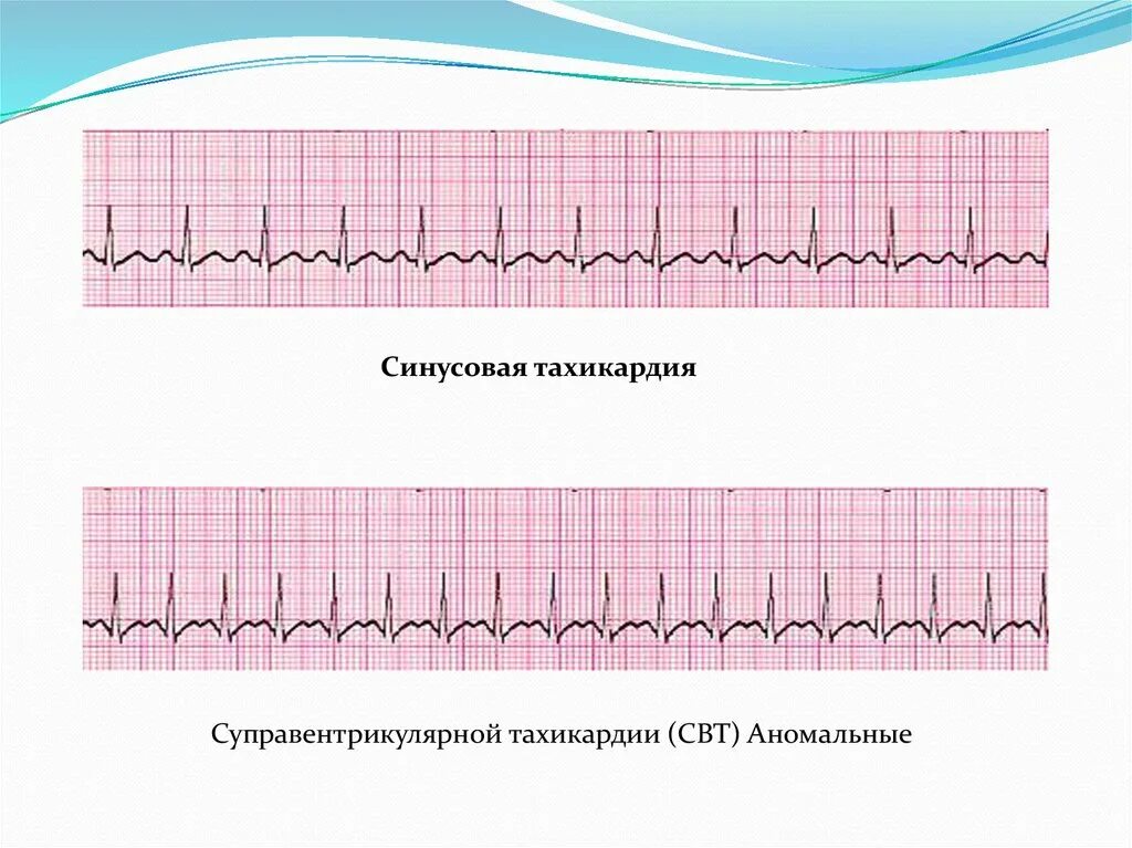 Синусовая тахикардия вертикальное. ЭКГ тахикардия синусовый ритм. Синусовая тахикардия на ЭКГ. Тахикардия на ЭКГ. ЭКГ при синусовой тахикардии.