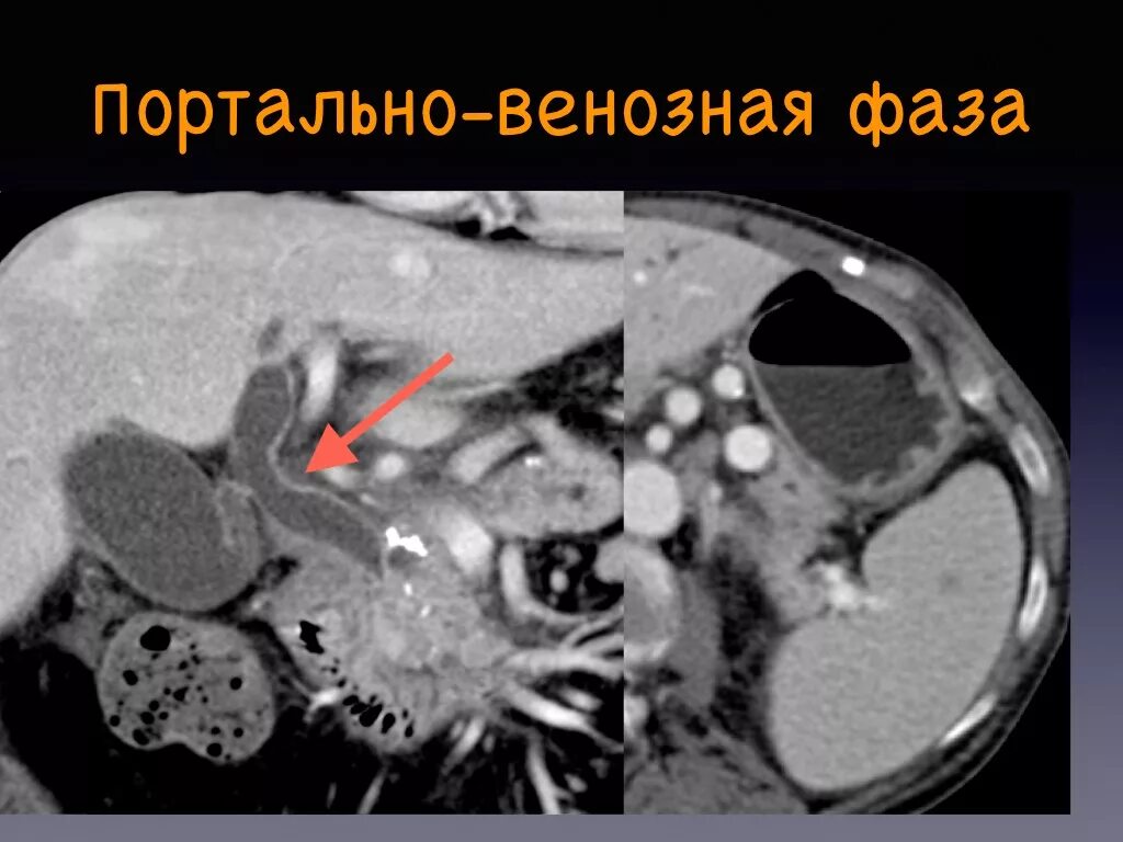 Фазы кт. Воротная вена на кт брюшной полости. фазы контрастирования на кт. тромбоз портальной вены кт.