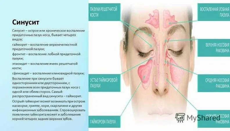 Фронтит лечение эффективное. Профилактика синусита. синусит гайморит фронтит. воспаление придаточных пазух носа.