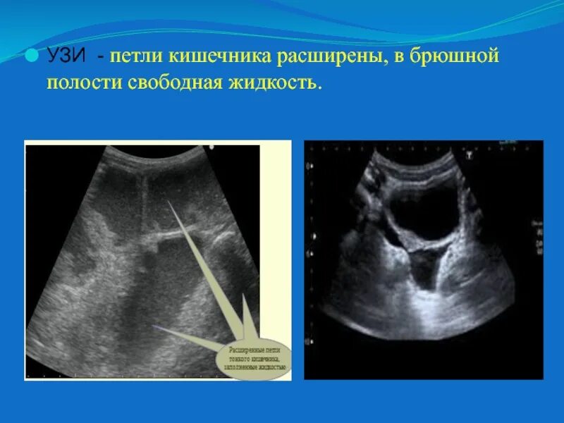 Узи брюшной полости ля фам. Жидкость в брюшной полости на УЗИ. Свабоднойжидкости в брюшной полости. Свободная жидкость в брюшной полости по УЗИ. Петли кишечника на УЗИ брюшной полости.