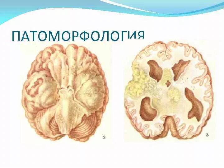 Мозговой туберкулез