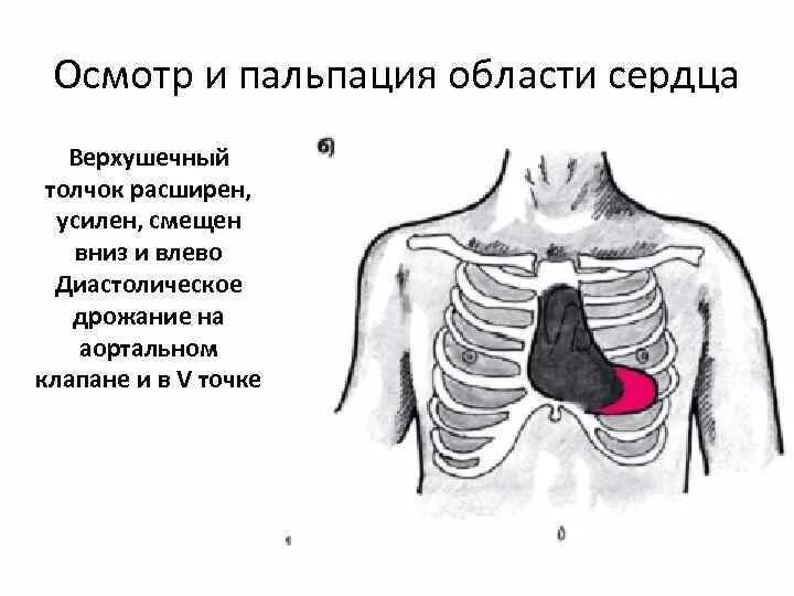 Что значит сердце увеличено влево. Пальпация области сердца верхушечный толчок. расширение границ сердца влево. сердечный толчок сердца.