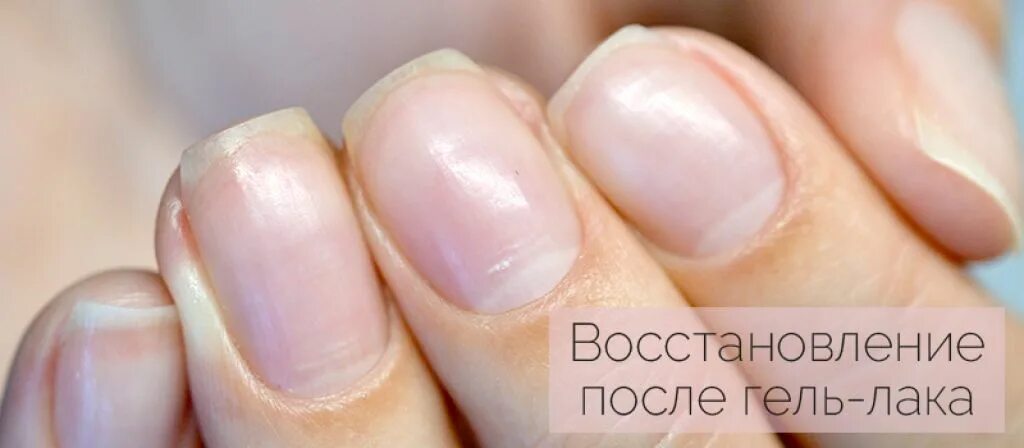 Что делать после снятия ногтя. Восстановление ногтевой пластины.