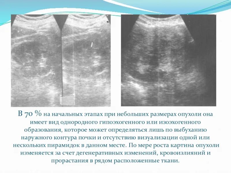 Гипоэхогенное округлое образование. Анэхогенные образования в почках. Гипоэхогенные почки. Гипоэхогенное образование в почке. Изоэхогенные образования почки.