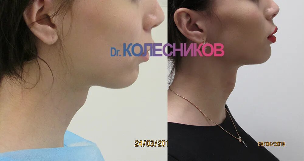 Как увеличить кадык. Щитовидная железа у мужчин. Операция по удалению кадыка. Увеличенная щитовидная железа. Кадык у женщин.