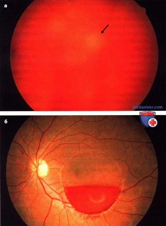 Гемофтальм мкб 10. Кровоизлияния гемофтальм. Гемофтальм глазное дно. Преретинальное кровоизлияние.