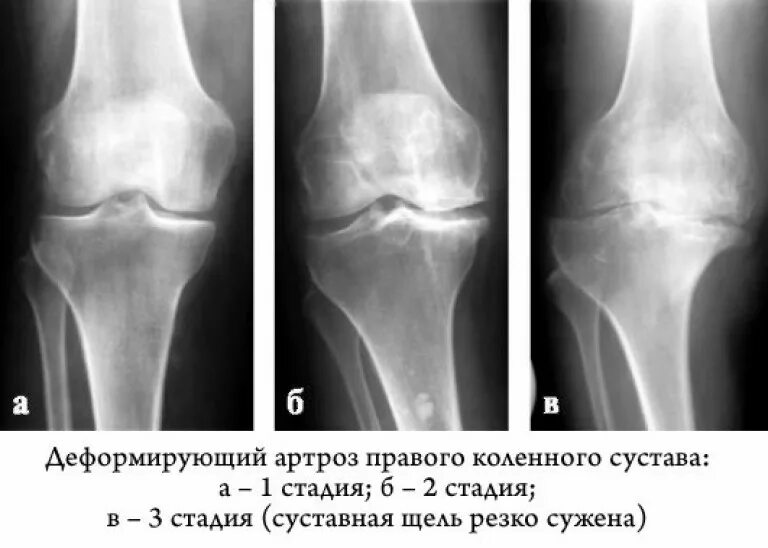 Деформирующий артроз коленного сустава 3 степени. Деформирующий гонартроз коленного сустава 2-3 степени. Деформирующий артроз 1 стадии коленного сустава. Деформирующий остеоартроз коленного сустава 2 стадии рентген.