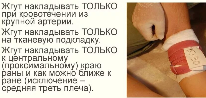 Максимальное время нахождения жгута на конечности. Правила наложения жгута при артериальном кровотечении. Сколько жжет. Наложение жгута летом и зимой. Сколько жжет.