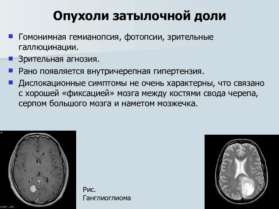 Симптомы опухоли головного мозга на ранних стадиях. Опухоли затылочной доли симптомы. Клинические проявления опухоли лобной доли:. Опухоли височной доли головного мозга клиника. Очаговые симптомы опухоли затылочной доли.