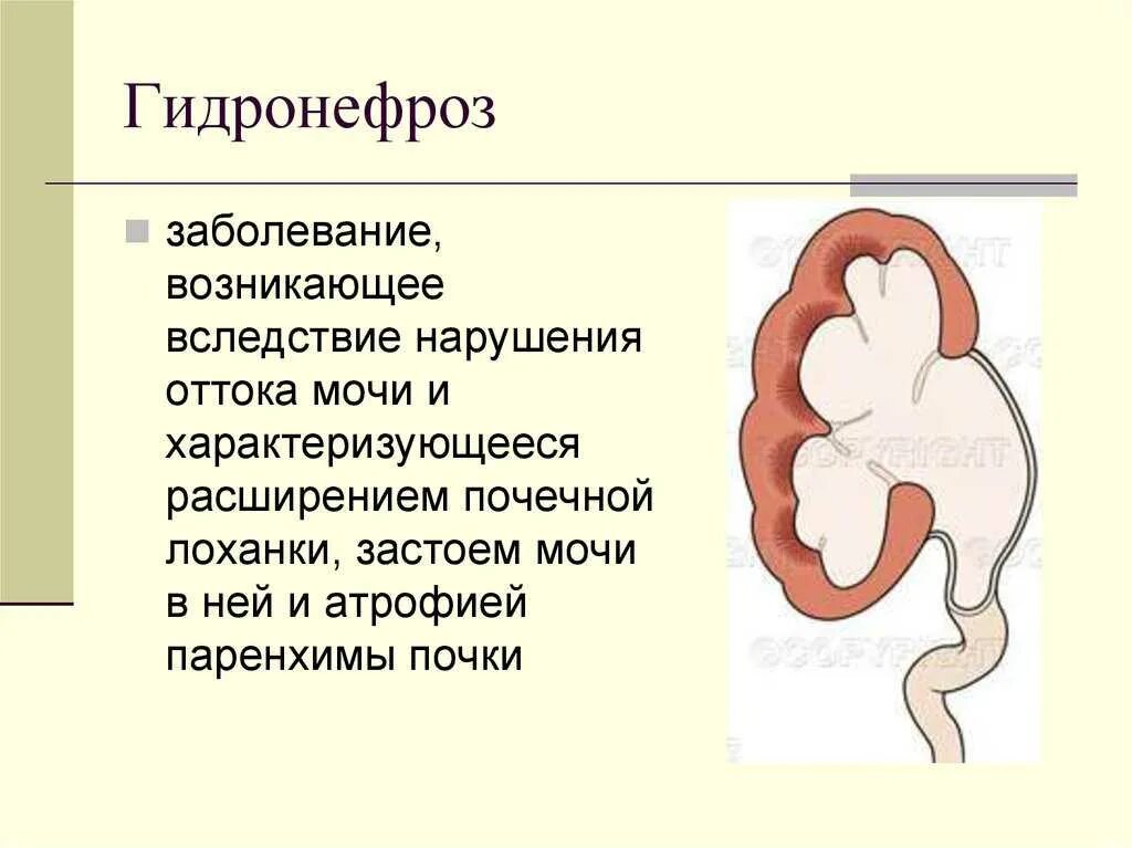 Почка воспаление гидронефроз. Гидронефроз почек этиология. Гидронефроз 1ст левой почки. Расширение лоханки гидронефроз. Причины расширения почек