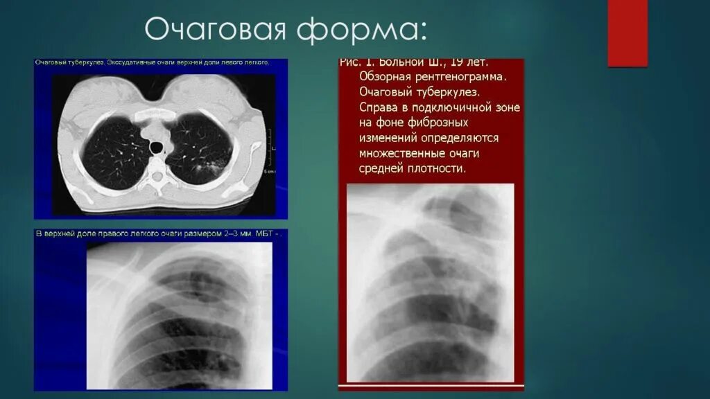 Туберкулез легких лучевая диагностика фтизиатрия. Очаговый туберкулез компьютерная томография. Очаговый туберкулез легких на кт. Очаговый туберкулез на кт.