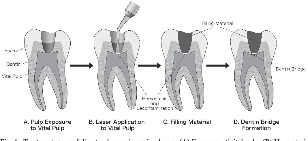 Filling material. Как выглядит пульпа зуба. Deep Dentin схема нанесения.