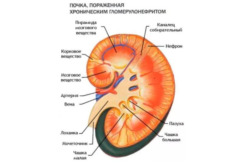 Заболевание почек гломерулонефрит. Почечные симптомы подострого гломерулонефрита. Поражение клубочков гломерулонефрит. Острый гломерулонефрит картина. Почка пораженная гломерулонефритом.