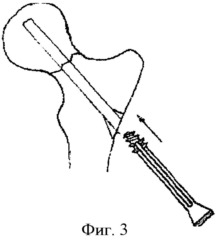 Шейка бедра перелом остеосинтез. Перелом шейки бедра аппарат. Металлоостеосинтез шейки бедра. Пластина для остеосинтеза шейки бедра патент. Операция остеосинтез шейки бедра