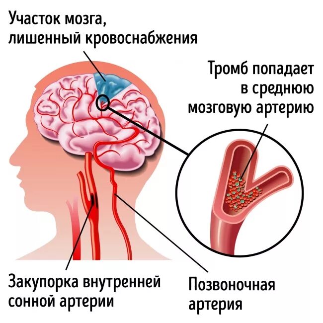 Головной тромб. Ишемический инсульт сонной артерии. инсульт ишемический это тромбоз. ишемия ишемический инсульт мозга. исход ишемического инсульта головного мозга патанатомия.
