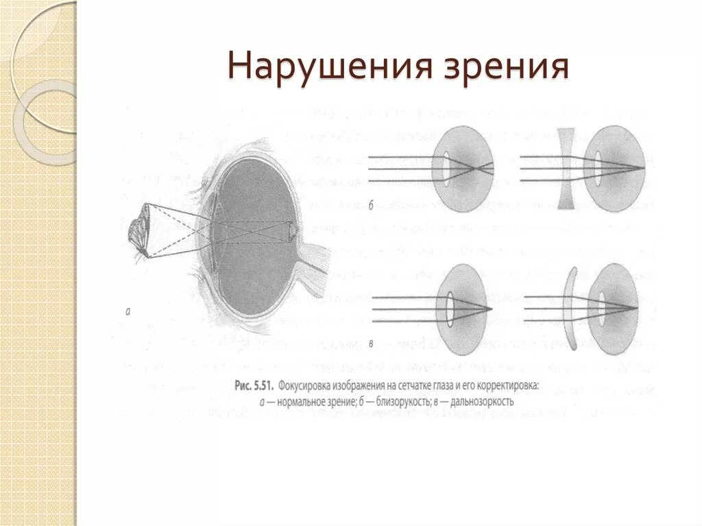 Нарушение зрения. Нарушение зрения схема. Виды нарушенного зрения схема.