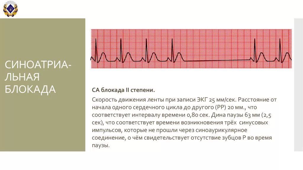 Са блокада 2 ст на ЭКГ. Са блокада 2 степени 1 типа на ЭКГ. Внутрипредсердная блокада на ЭКГ. Блокада са узла ЭКГ.