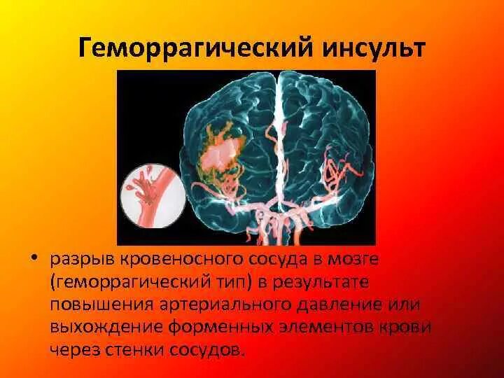 Инсульт геморрагический правая. Геморрагический инсульт. Геморрагический инсульт сосуды. Геморрагический инсульт группы. Геморрагический инсульт первые три дня.