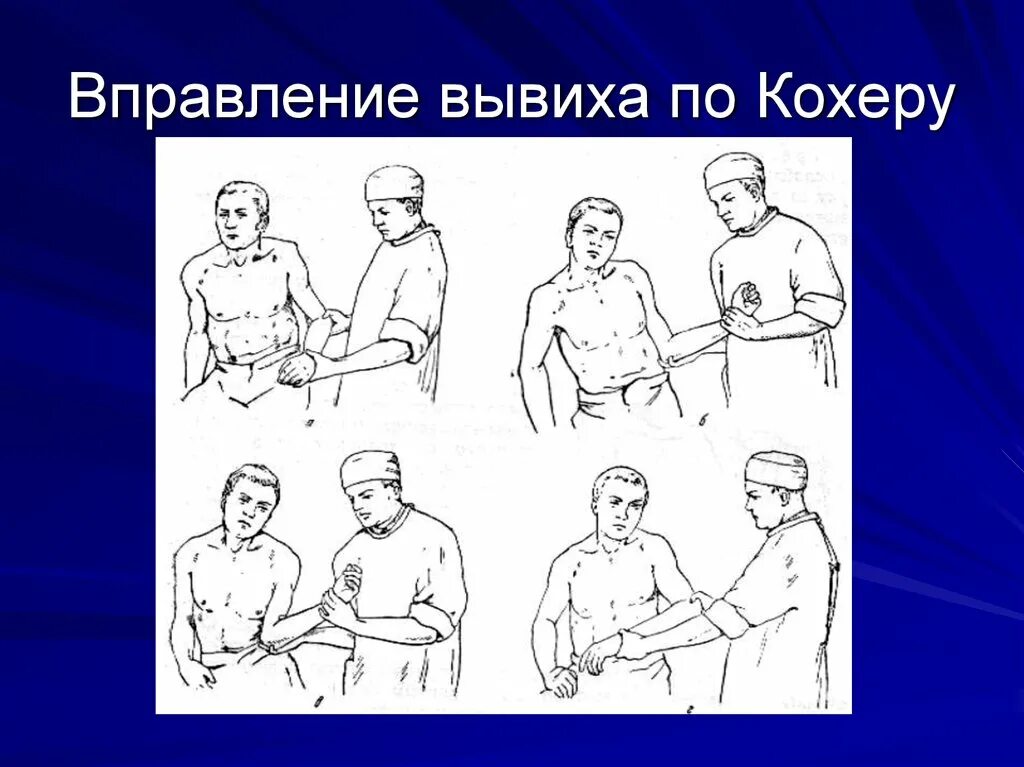 Методика вправления вывиха плеча. Метод кохера вправление плеча. Вправление переднего вывиха плеча. Вправление вывиха плеча (методом кохера). Вправление вывиха плеча.