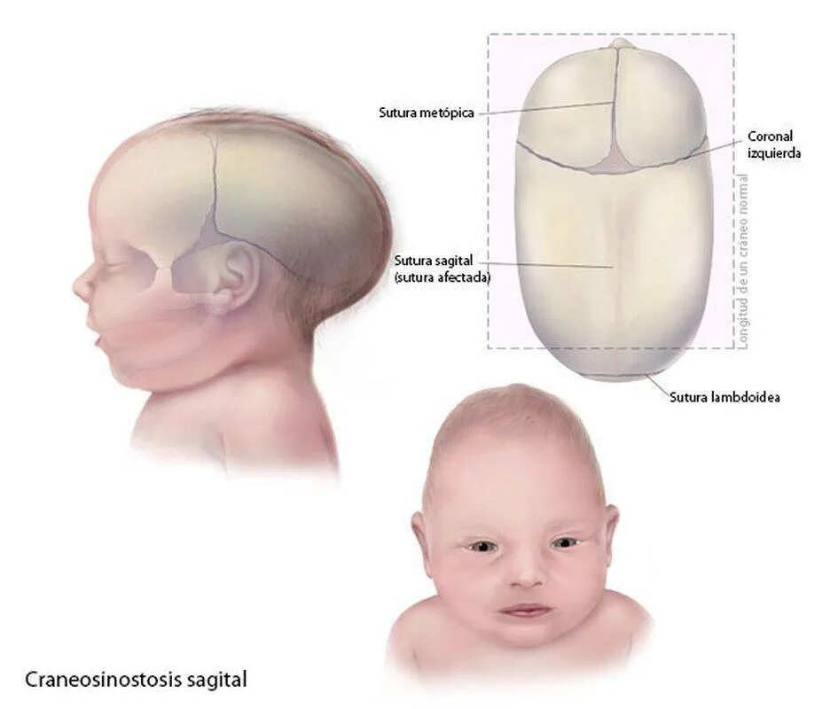Деформация кости черепа. Сагиттальный шов черепа новорожденного. Краниостеноз формы черепа. Форма головы сбоку младенца. Коронарный краниостеноз.