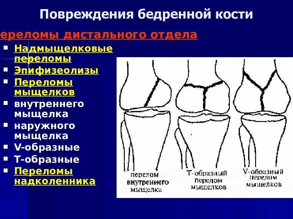 Повреждение медиального мыщелка. Переломы мыщелков бедренной кости классификация. Перелом мыщелка бедренной кости. Т-образный перелом мыщелков бедренной кости. Перелом мыщелка бедренной кости классификация.