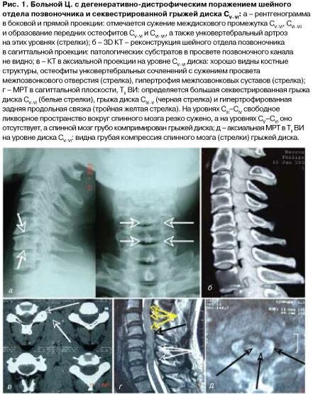 Мр картина дистрофических изменений поясничного отдела позвоночника. Дегенеративные изменения позвоночника. Дистрофические изменения пояснично-крестцового отдела. Дегенеративные изменения пояснично-крестцового отдела позвоночника. Дегенеративно-дистрофические изменения позвоночника что это.