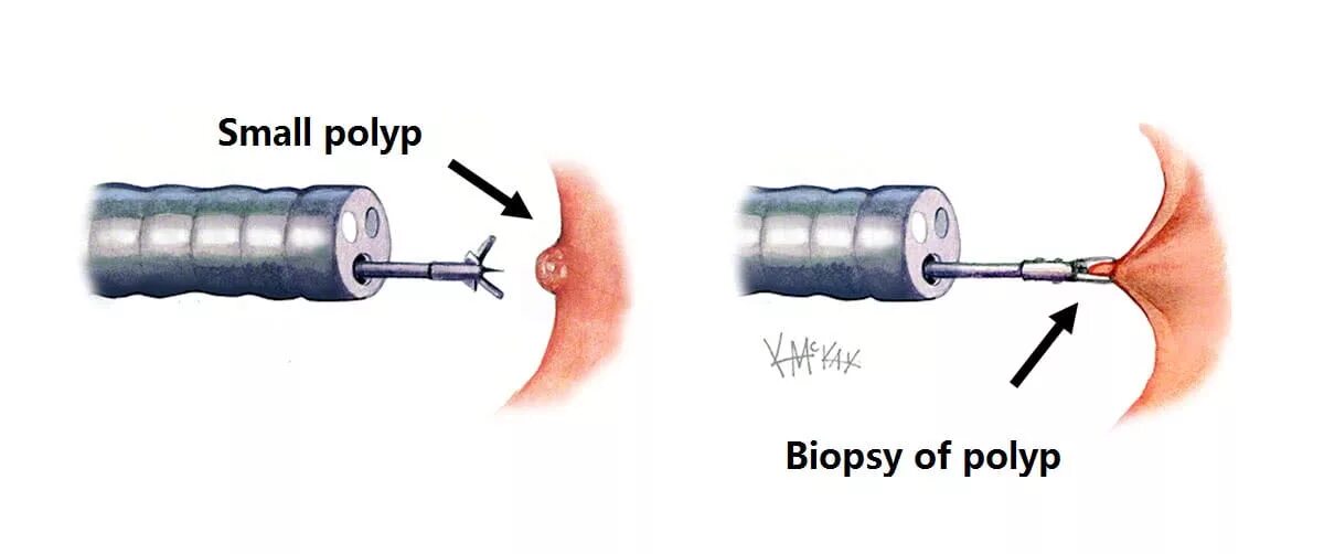 Тотальная эксцизионная биопсия. Биопсия слизистой Толстого кишечника. Биопсия полипа кишечника. Эндоскопическая петлевая электроэксцизия полипов. Биопсия язвы