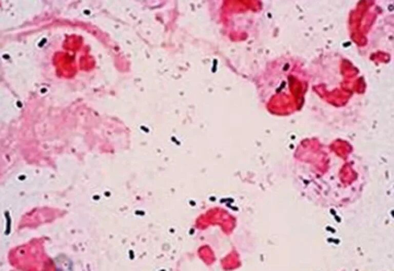 Haemophilus в мазке у мужчин. Гемофильная инфекция возбудитель. Гемофильная палочка микроскопия. Haemophilus influenzae под микроскопом. Гемофильная палочка в мазке.