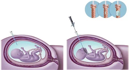 Фетоскопия (амниоскопия). Внутриутробная хирургия плода. Фетоскопия. Фетальная хирургия:. Амниоцентез при многоплодной беременности. Фетальная хирургия