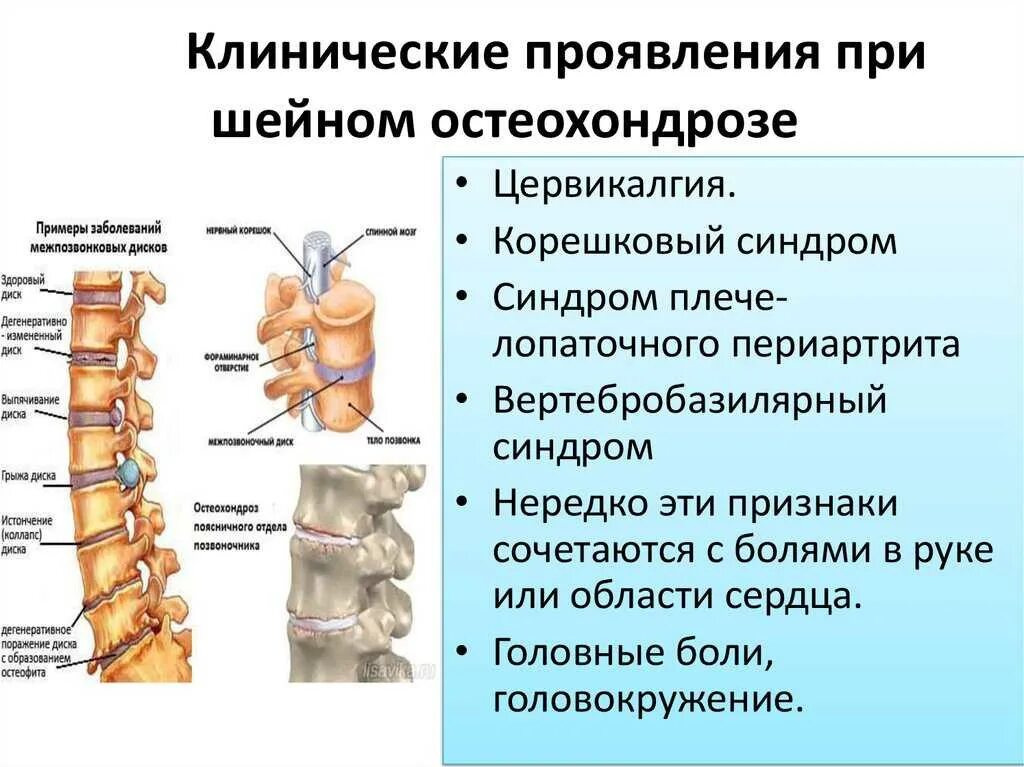 Корешковый остеохондроз грудного отдела. Хрящи в позвоночнике. Корешковый болевой синдром. Корешковый болевой синдром. Корешковый остеохондроз грудного отдела.