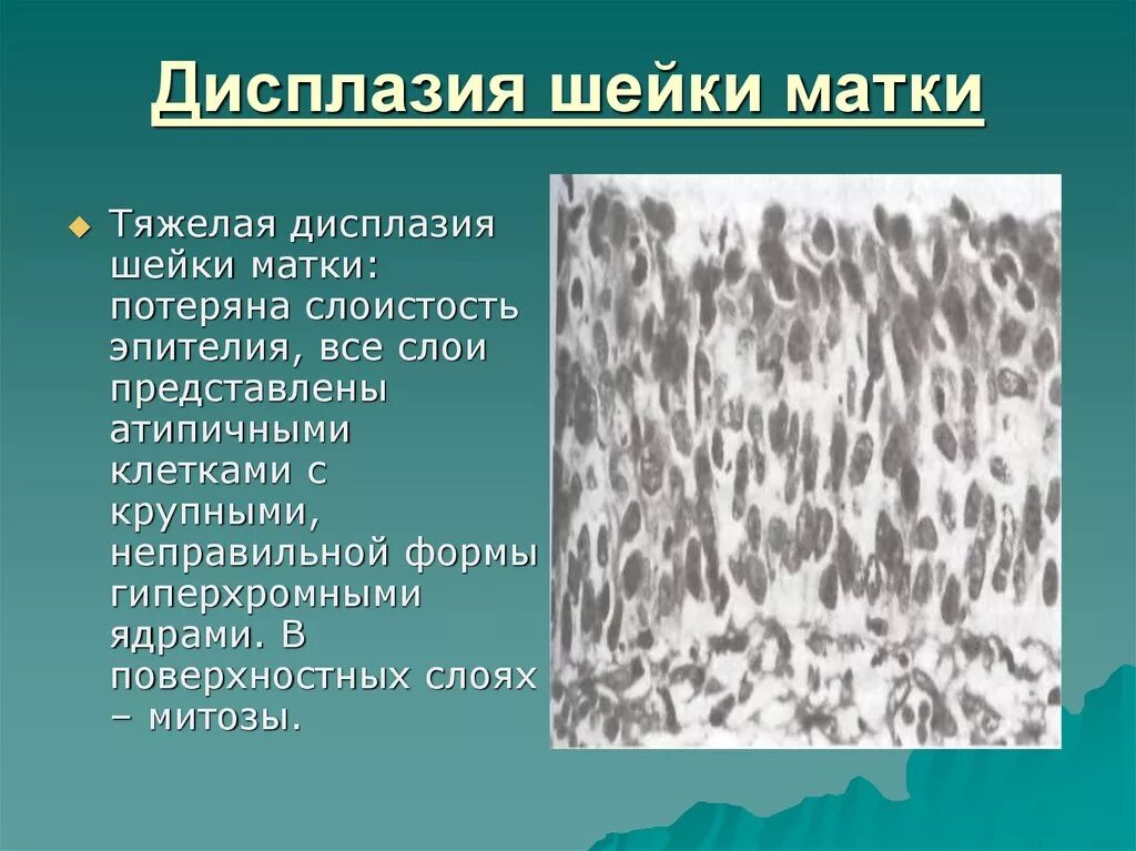 Дисплазия эпителия шейки матки. Тяжелая дисплазия эпителия шейки матки это. Клетки с гиперхромными ядрами