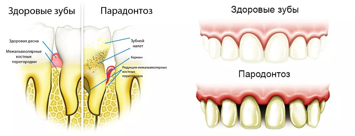 Признаки лечения зубов. Пародонтоз клинический. Зубы с кариесом и пародонтозом.