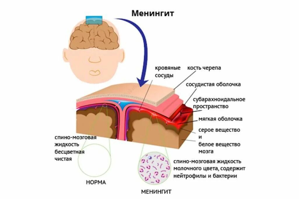 Воспаление серозной оболочки. Менингит воспаление оболочек головного мозга. Воспаление мозговых оболочек симптомы у ребенка. Симптомы поражения мозговых оболочек при менингите. Менингит-инфекционное заболевание симптомы.