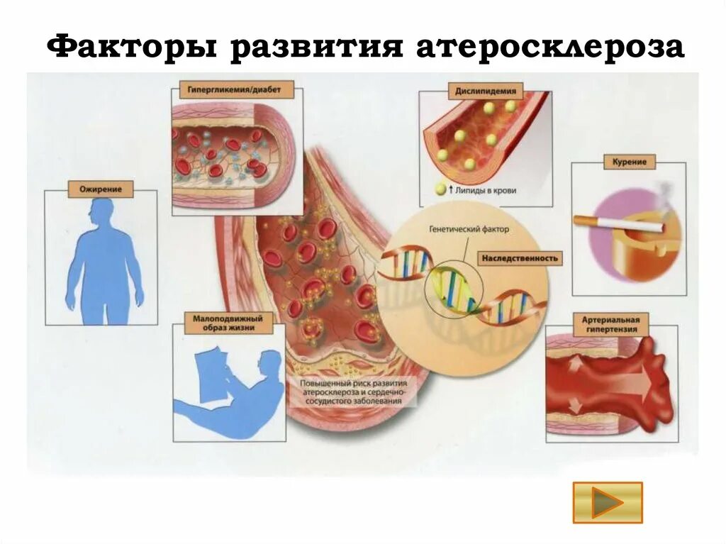 Фактором развития атеросклероза является. Атеросклероз сосудов факторы риска. факторы способствующие развитию атеросклероза. атеросклероз. причины развития. факторы риска. осложнения.. факторы риска развития атеросклероза сосудов:.