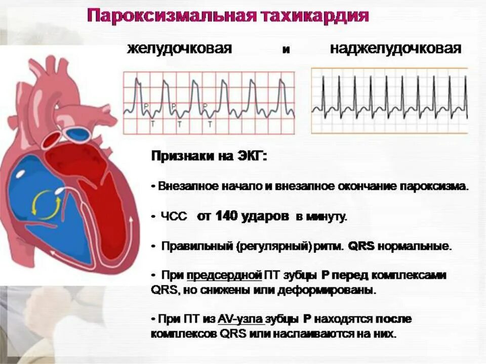 Тахикардия лечится или нет. Пароксизмальная тахикардия экг. наджелудочковая тахикардия.