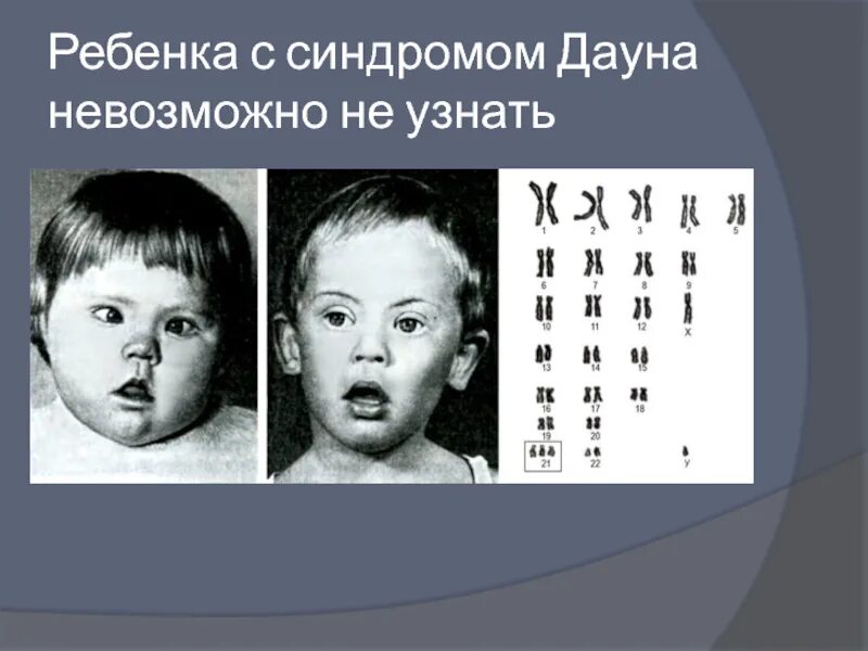 Заболевание болезнь дауна. Синдром Дауна трисомия по 21 хромосоме. Мозаичный синдром Дауна внешность. Болезнь Дауна мозаичная форма.