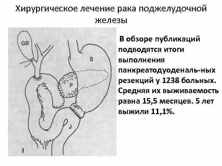 Есть при раке поджелудочной железы. Онкопатологии поджелудочной железы. Опухоли поджелудочной железы классификация. Карцинома головки поджелудочной железы. Опухоли поджелудочной железы хирургия.