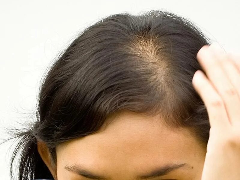 Диффузное выпадение волос. Выпадение волос картинки. Female pattern hair loss. Выпадают волосы 50 лет