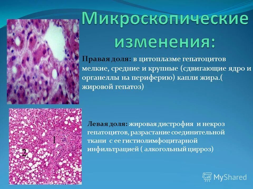 дистрофия цитоплазмы