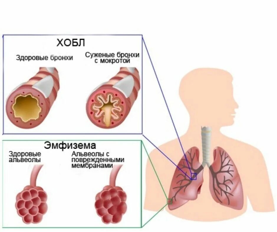 Поражение легких лечение. ХОБЛ хроническая обструктивная болезнь. Обструктивная болезнь легких — ХОБЛ. Хроническое заболевание легких ХОБЛ. ХОБЛ легких 4 стадия.