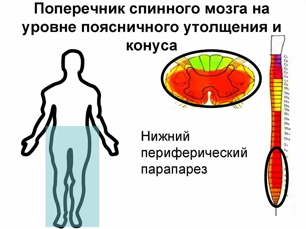 Симптомы поражения поясничного утолщения спинного мозга. Признаки поражения спинного мозга на уровне поясничного утолщения. Поражение спинного мозга на уровне поясничного утолщения. Поражение спинного мозга на уровне поясницы.