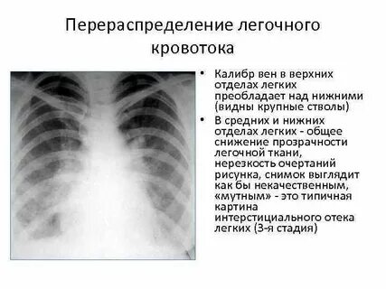 Нарушения легочного кровообращения