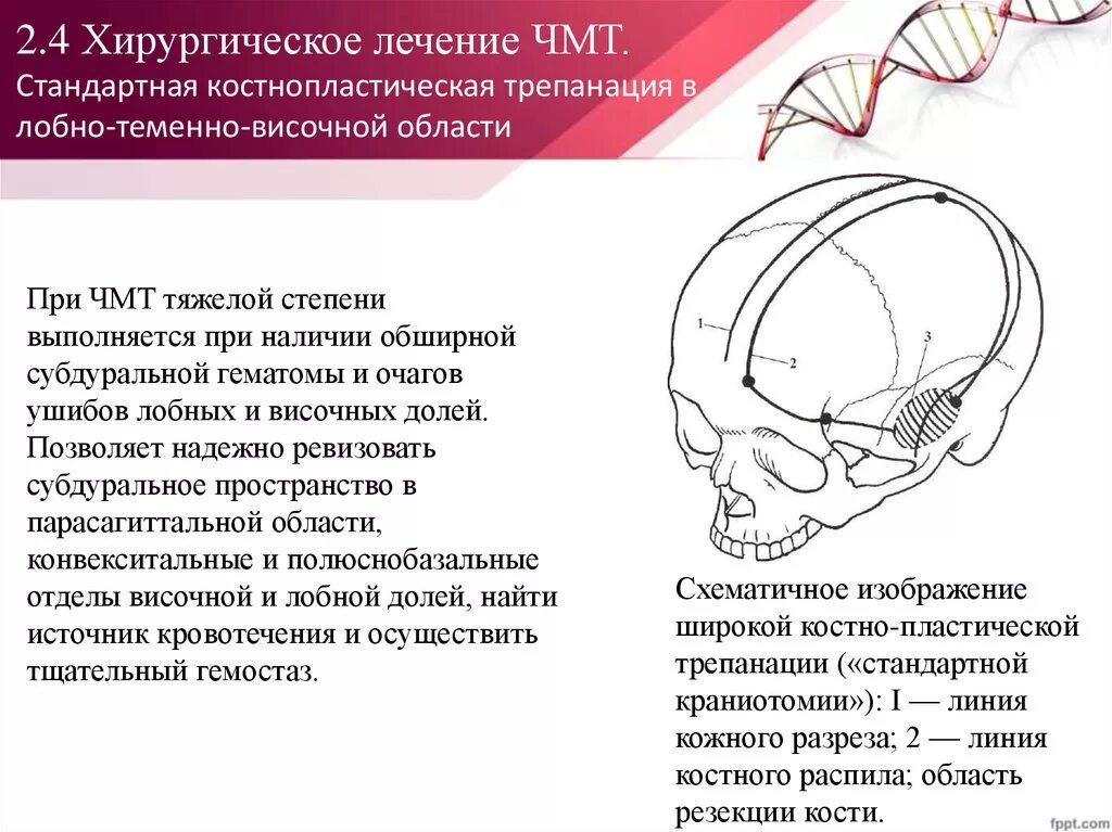 Трепанация затылочной части черепа. Костно пластическая Трепанация в теменно височной области. Трепанация черепа при черепно мозговой. Черепно мозговые операции