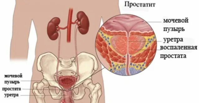 Последствие простаты. Как выглядит воспаление простаты. Последствия простатита для мужчин.