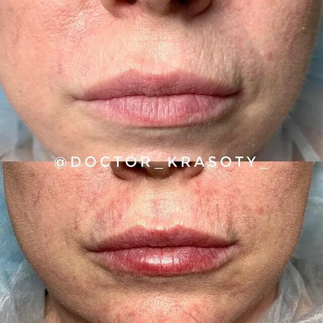 5 мл. асимметрия губ после увеличения. контур губ гиалуроновой кислотой 1 мл. губы накаченные гиалуроновой кислотой 1 мл. увлажнение губ гиалуроновой кислотой 0.