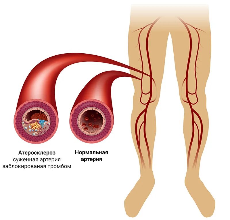 Почему горят сосуды. Облитерирующий атеросклероз сосудов конечностей. Облитерирующий атеросклероз вен нижних конечностей. Облитерирующий атеросклероз периферических артерий. Заболевания сосудов нижних конечностей атеросклероз.