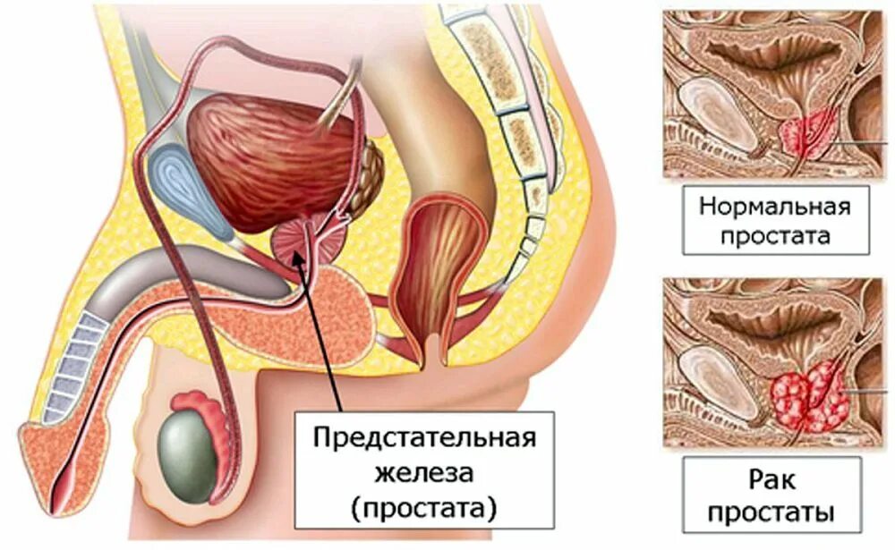 Простата действий. Предстательная железа у мужчин. Опухоль предстательной железы. Простата железа у мужчин.